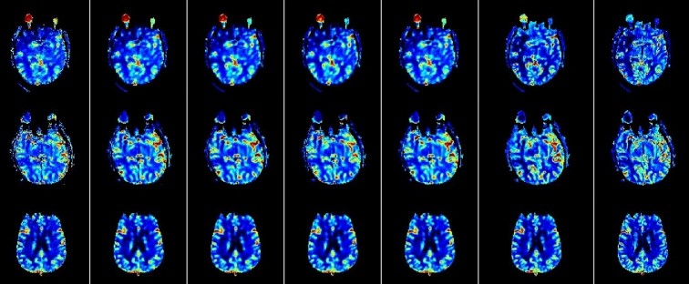 A Machine Learning Approach to Perfusion Imaging With Dynamic Susceptibility Contrast MR